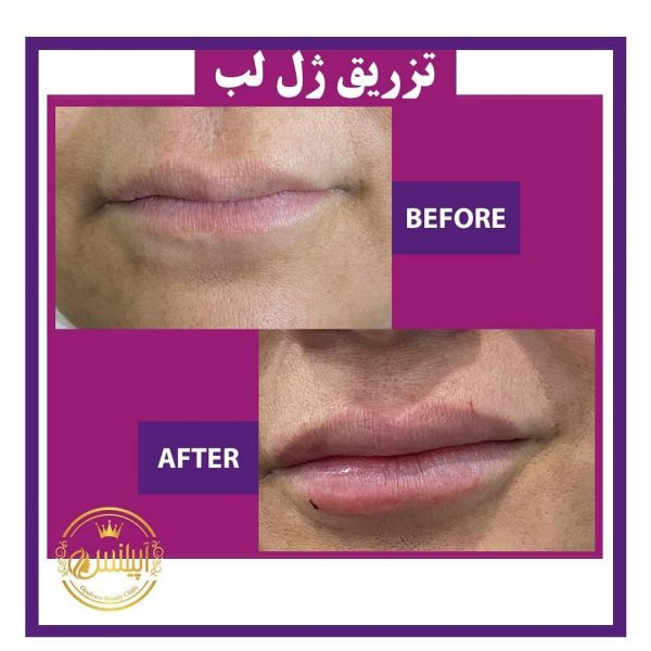 ژل لب کرج نمونه تزریق ژل لب کرج تهران