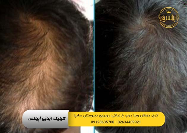 قبل و بعد مزوتراپی