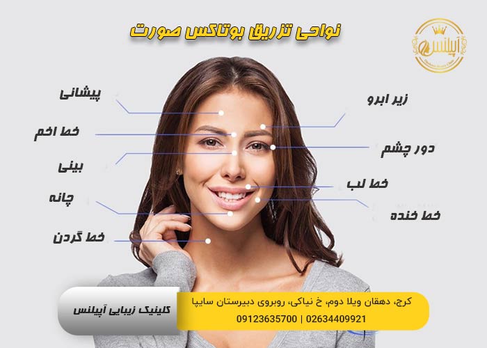 ناحیه های بوتاکس صورت در کرج