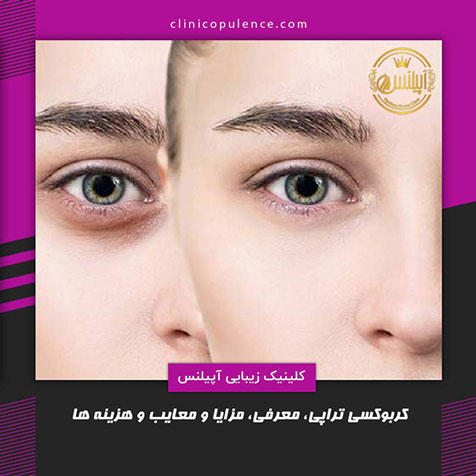 کربوکسی تراپی در کرج