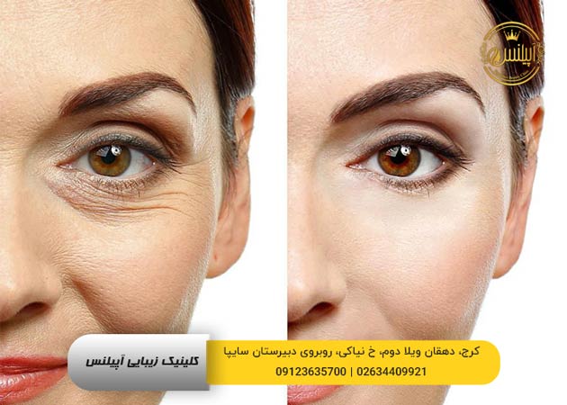 رفع تیرگی چشم با کربوکسی تراپی در کرج