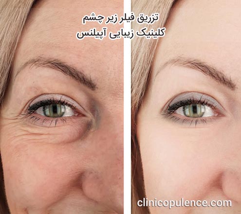 قبل و بعد تزریق فیلر چشم