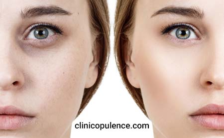 تزریق فیلر زیر چشم کرج