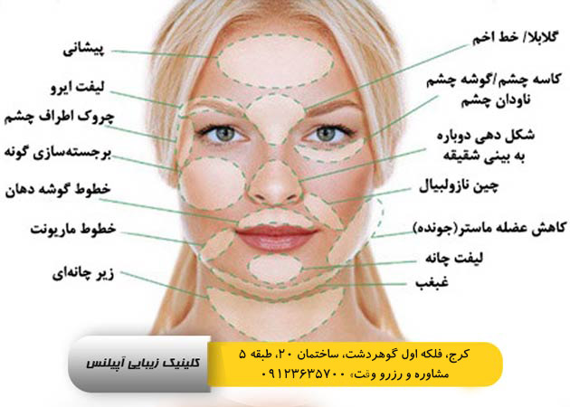 لیفت صورت با نخ در کرج هزینه و انواع