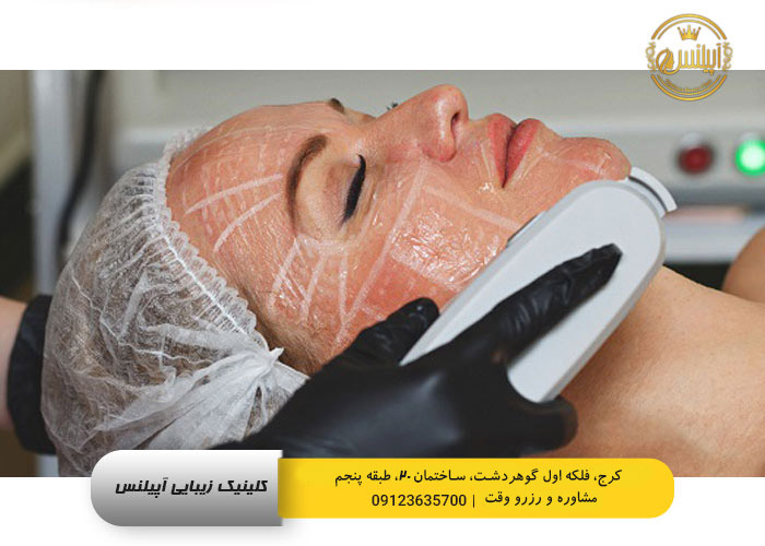 هایفوتراپی صورت در کرج در مرکز لاغری آپیلنس