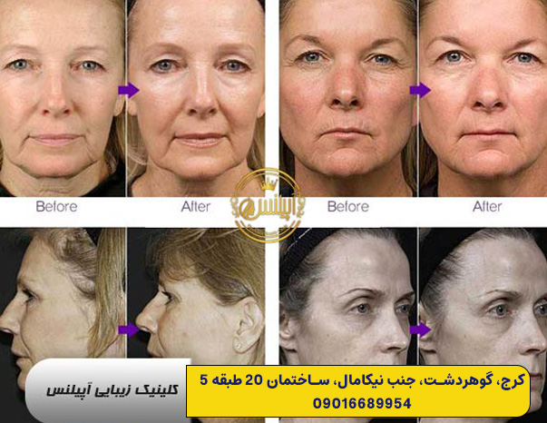 قبل و بعد هایفوتراپی در کرج