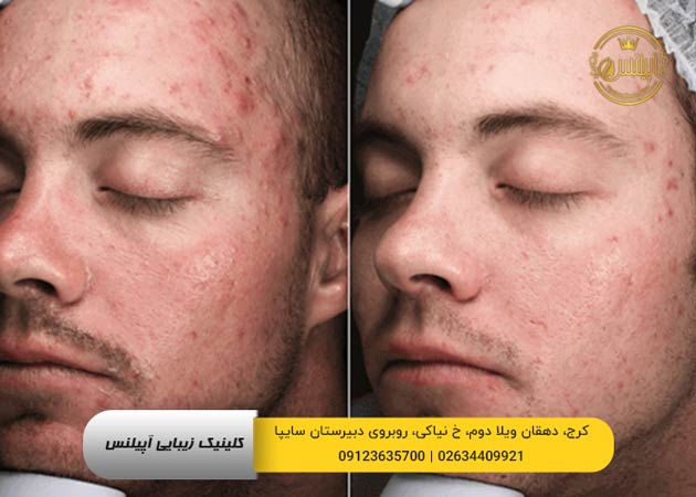 مزونیدلینگ پوست صورت 