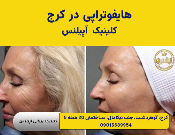  تخفیف هایفوتراپی صورت در کرج