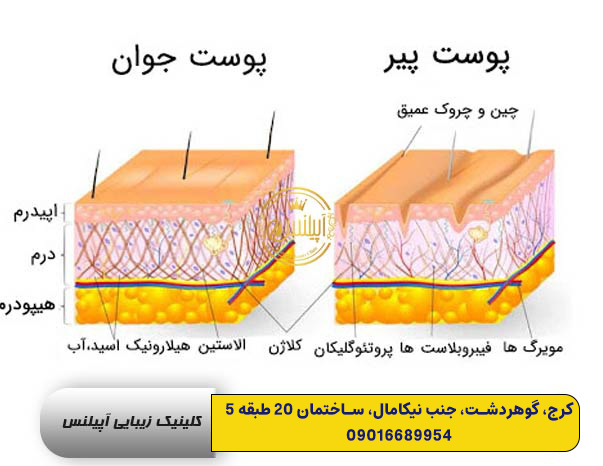 نحوه اجرای هایفوتراپی در کرج