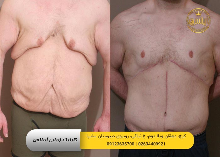قبل و بعد پیکرتراشی 