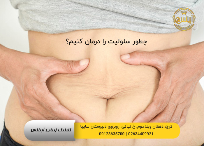 برطرف کردن چربی شکم و سلولیت در کرج