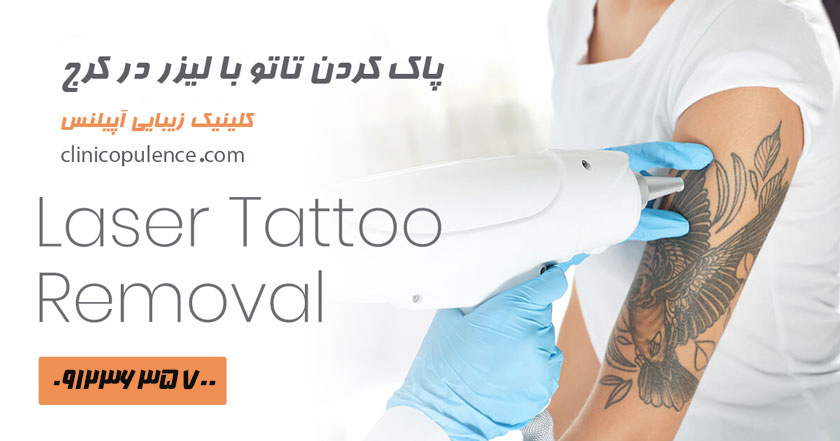 پاک کردن تتو در کرج
