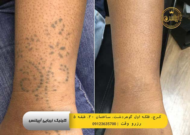 تتو ریموال در تهران و کرج پاکسازی جای تتو