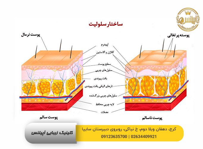 شماتیک سلولیت