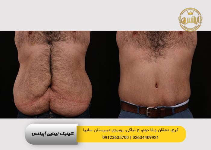 قبل و بعد کانتورینگ بدن