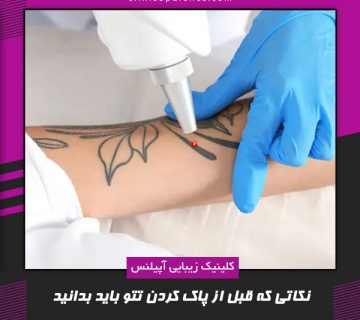 تتو ریموال کرج