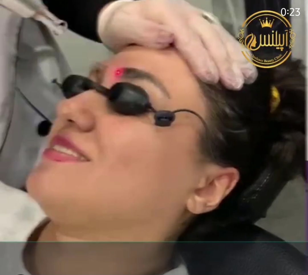 پاک کردن تاتو در کرج