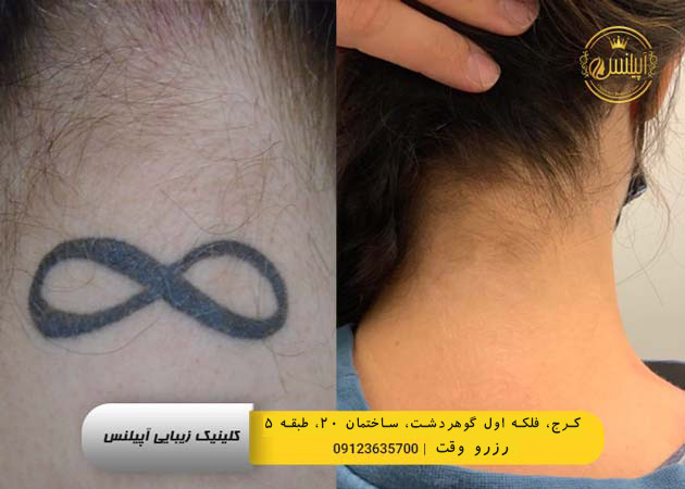 پاک کردن تاتو کرج