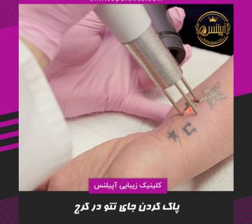 رفع جای تتو با لیزر در کرج
