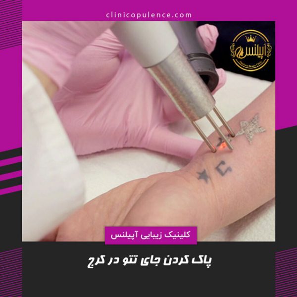 رفع جای تتو با لیزر در کرج