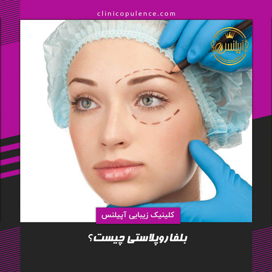 بلفاروپلاستی در کرج