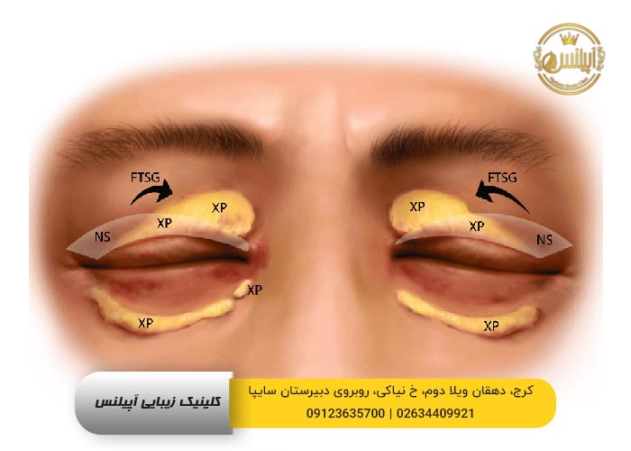 روش عمل بلفاروپلاستی کرج