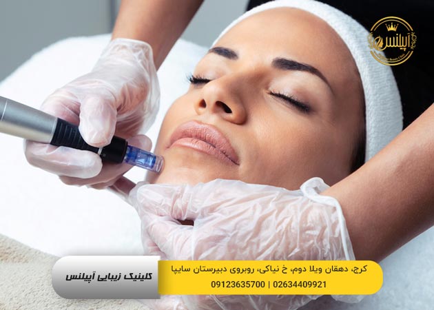 میکرونیدلینگ 