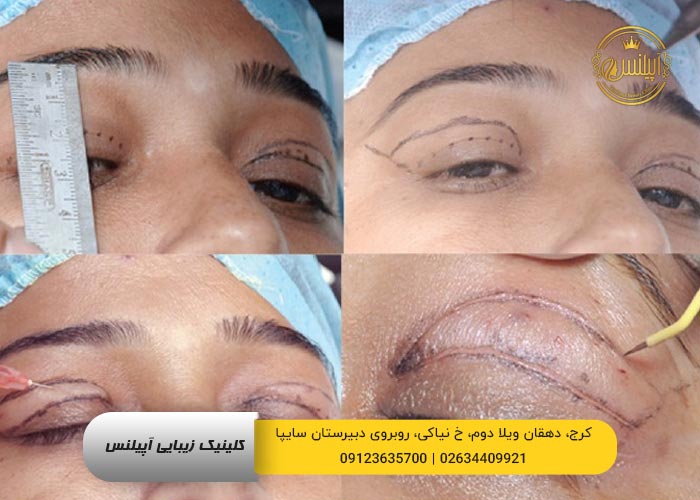 نمونه کار بلفاروپلاستی