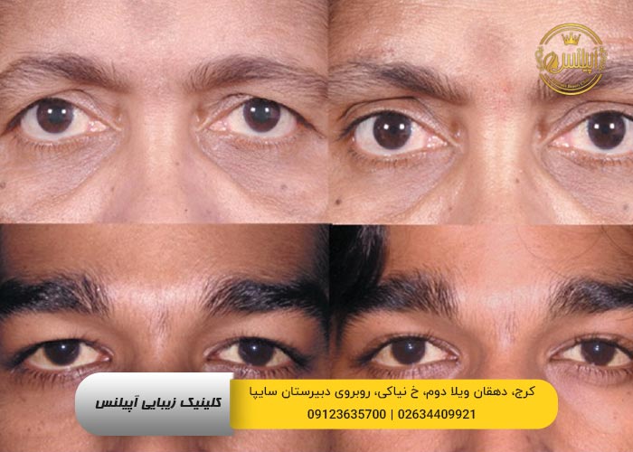 نمونه بلفاروپلاستی در کرج کلینیک آپیلنس