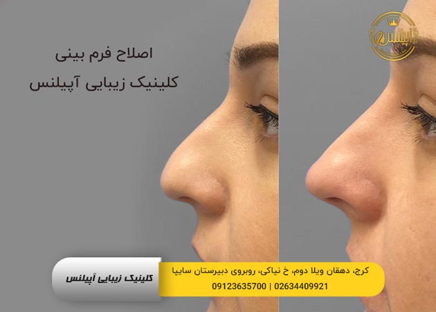 قبل و بعد فیلر بینی در کرج