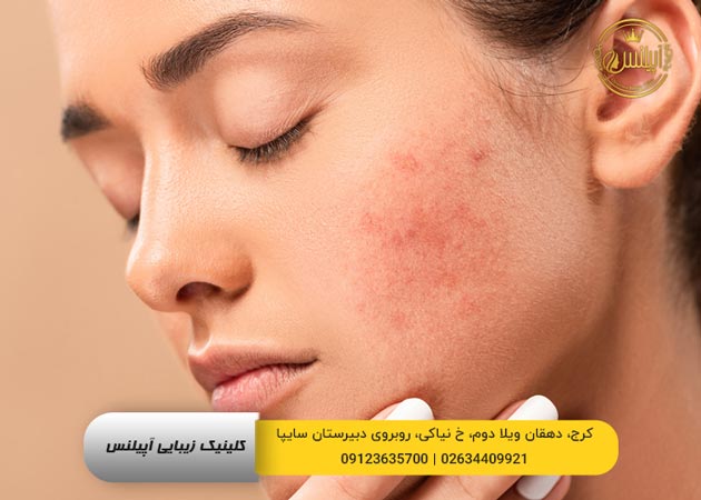 رفع اکنه و لک کرج