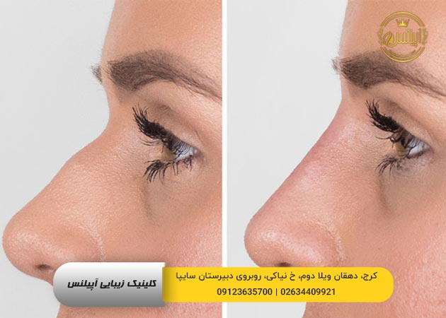 باریک کردن بینی کرج
