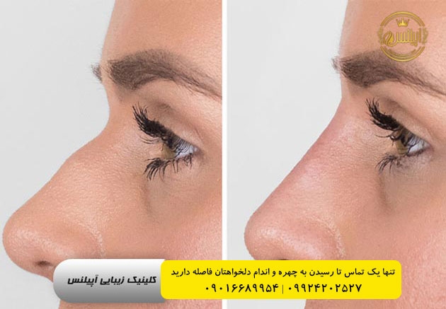آنزیم کوچک کننده اندازه بینی