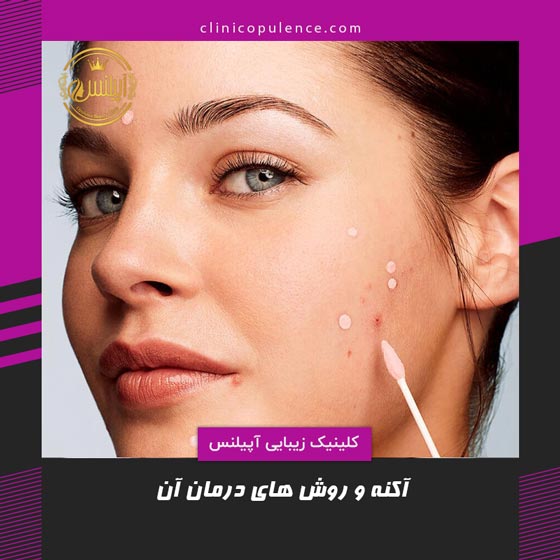 درمان آکنه در کرج