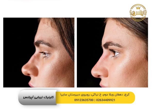 رفع قوس بینی حذف قوس
