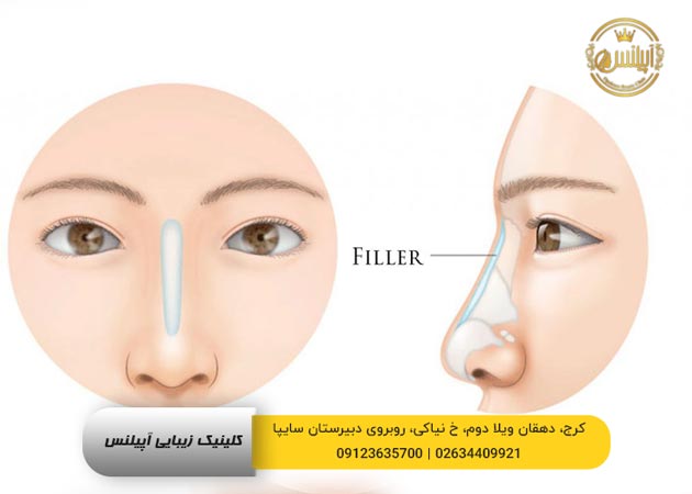 شماتیک عمل پرکردن بینی 