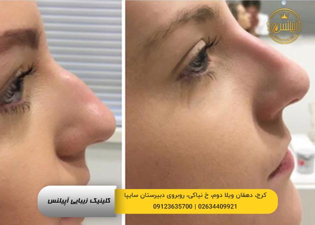 قبل و بعد فیلر بینی 