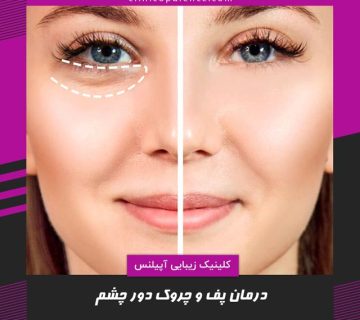 تیرگی زیر چشم رفع و درمان در کرج