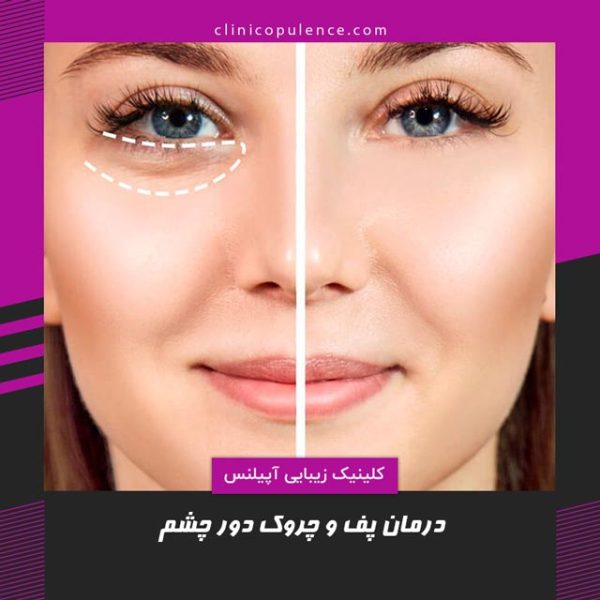 تیرگی زیر چشم رفع و درمان در کرج