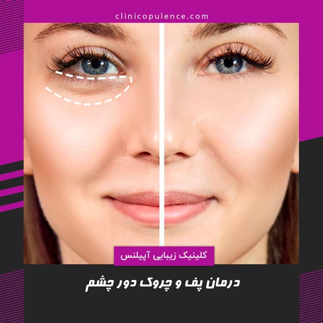 تیرگی زیر چشم رفع و درمان در کرج