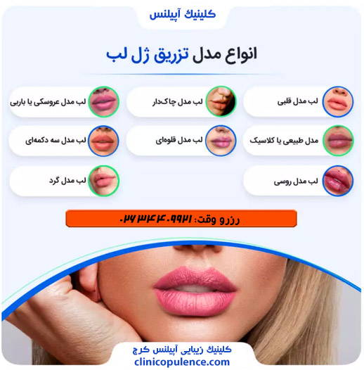 انواع مدل های ژل لب در کرج شامل عروسکی نچرال و روسی است