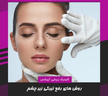 درمان سیاهی زیر چشم در کرج