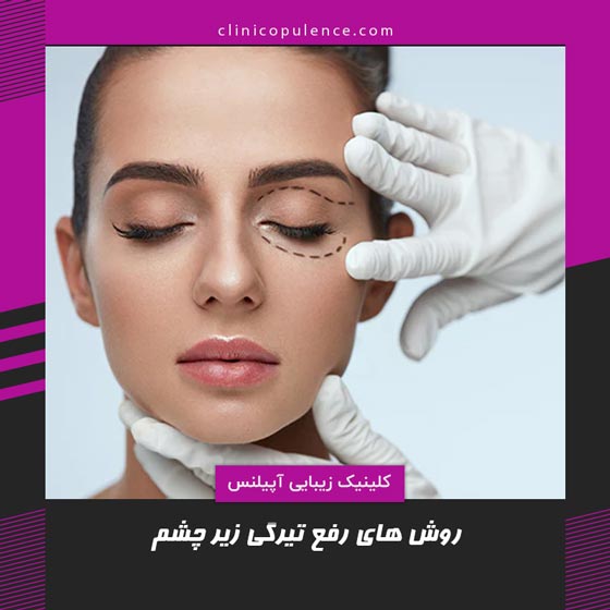 درمان سیاهی زیر چشم در کرج