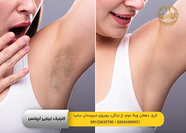 قبل و بعد تیرگی زیر بغل