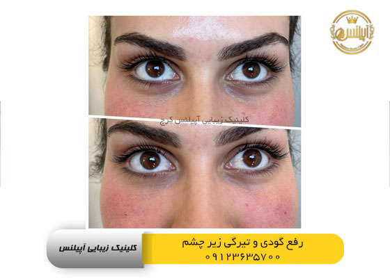 رفع گودی و سیاهی زیر چشم در کرج