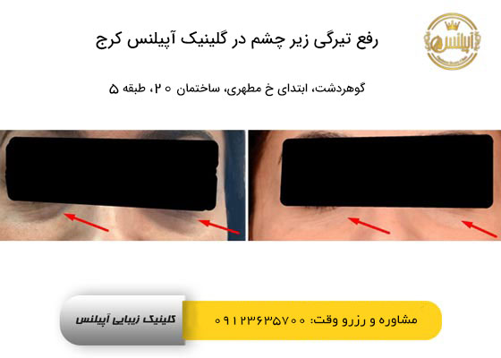 رفع تیرگی زیر چشم در کرج با فیلر