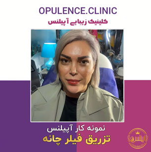 فیلر-چانه