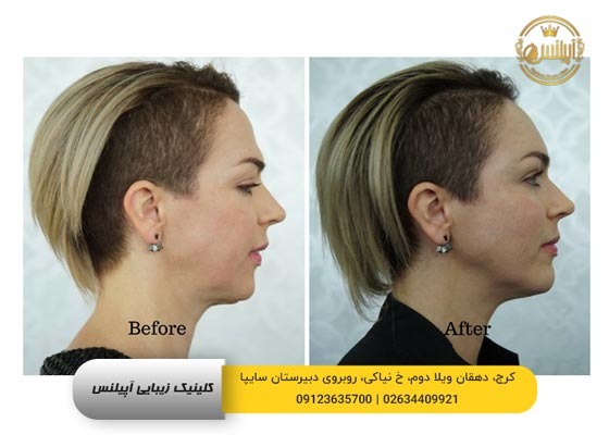قبل و بعد تزریق فیلر چانه