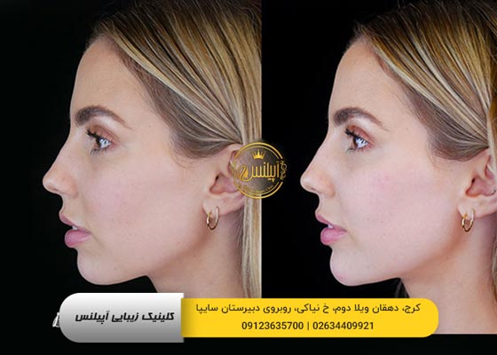 قبل و بعد فیلر فک