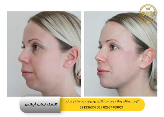تزریق فیلر چانه در کرج